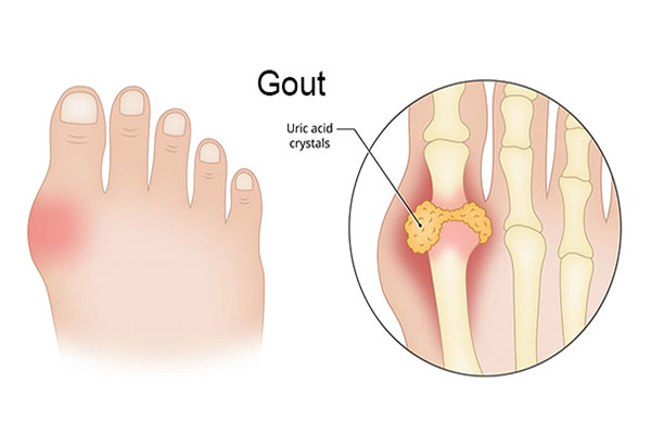 Hỗ Trợ Điều Trị Gout